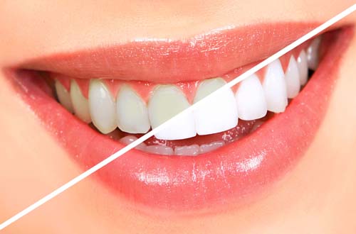 Косметическое отбеливание зубов magic white противопоказания