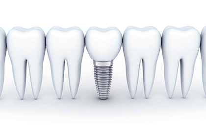 Сколько стоит поставить имплант 1 зуба?