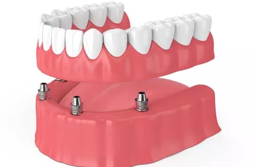 Одноэтапная имплантация зубов: минимум вмешательства, максимум эффекта