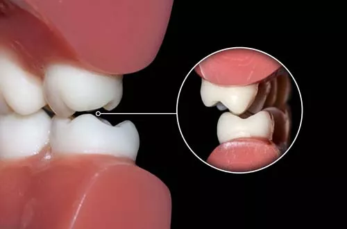 Импланты при полном отсутствии зубов: современная альтернатива съемному протезу