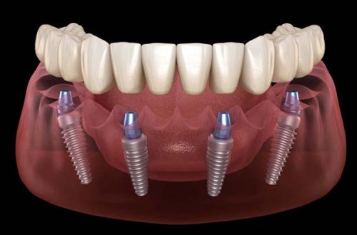 Полная имплантация зубов вместо съемного протеза: быстрый способ вернуть красоту и здоровье