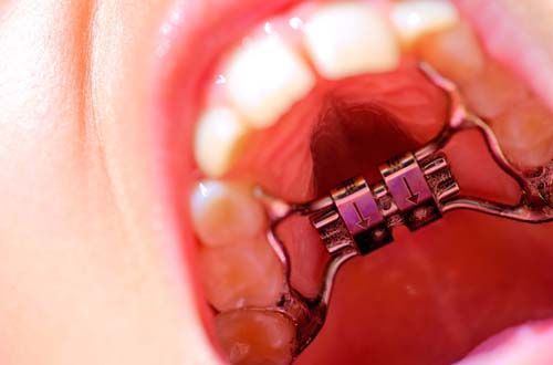 Внутренние брекеты: выравнивание зубов, о котором знаете только вы и ваш врач