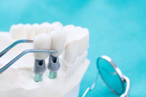 Что стоит запомнить, когда вы сомневаетесь, делать ли имплантацию зубов