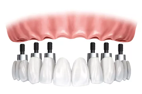 Базальная имплантация зубов