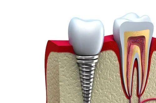 Сколько стоит поставить имплант 1 зуба?