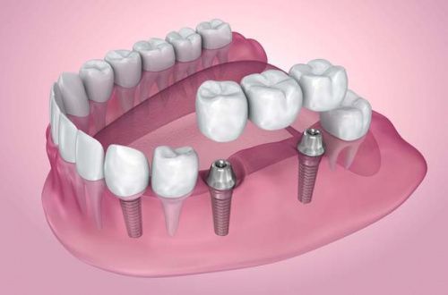 Импланты на жевательные зубы: секреты долгой службы