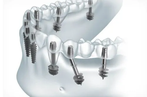 Выбор имплантов зуба
