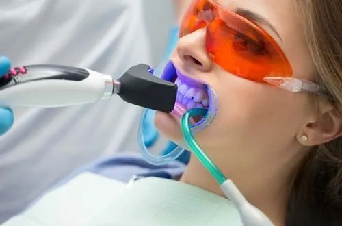 Профессиональное отбеливание зубов: в чем суть и преимущества
