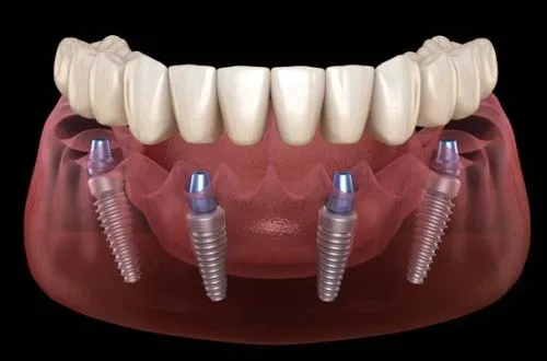 Полная имплантация зубов вместо съемного протеза: быстрый способ вернуть красоту и здоровье