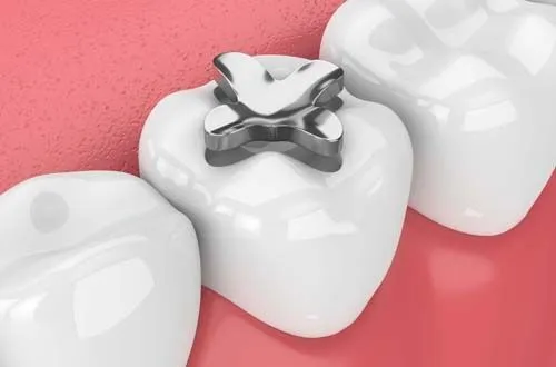 После установки пломбы: как продлить «жизнь» зуба