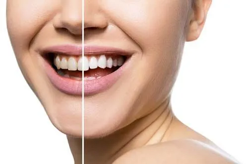 Эффективное отбеливание зубов и безопасность – совместимо или нет?
